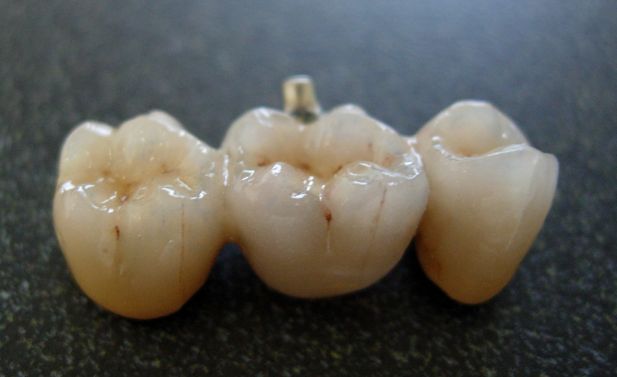 Dental porcelain bridge showing translucency and craftsmanship