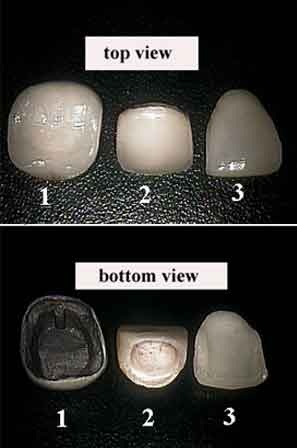 Comparison of dental crowns and porcelain veneers